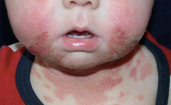 Hình ảnh viêm da cơ địa ở trẻ em giai đoạn đầu thường rất dễ nhầm lẫn