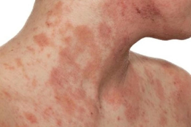 Hình ảnh viêm da cơ địa người lớn thường lan rộng và tái phát