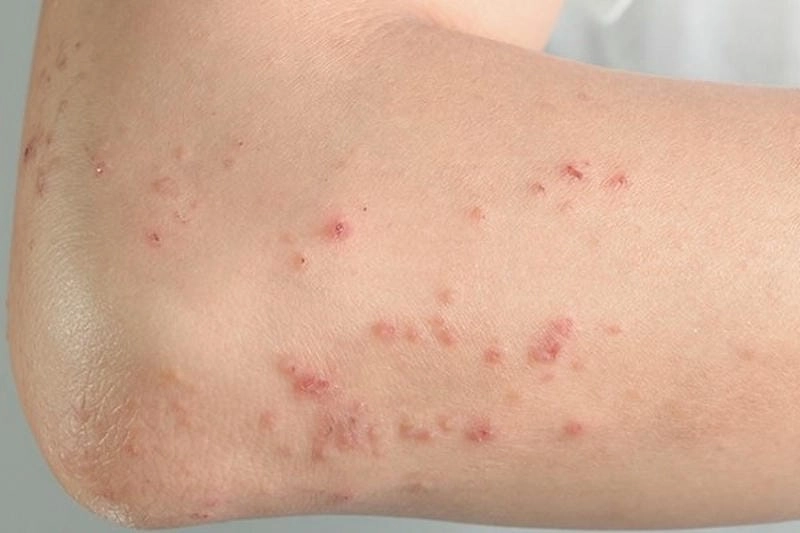 Viêm da cơ địa ở chân người lớn thường khô sần và đóng vảy dày