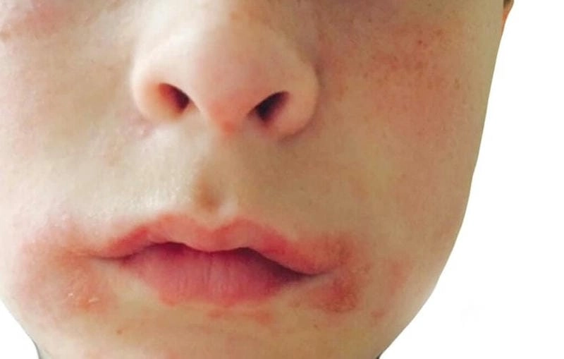 Hình ảnh bị viêm da cơ địa thường kèm nứt nẻ và tróc vảy da