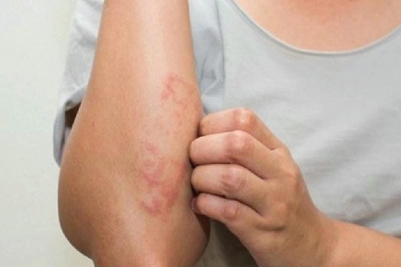 Hình ảnh viêm da cơ địa ở người lớn biểu hiện đa dạng từng giai đoạn