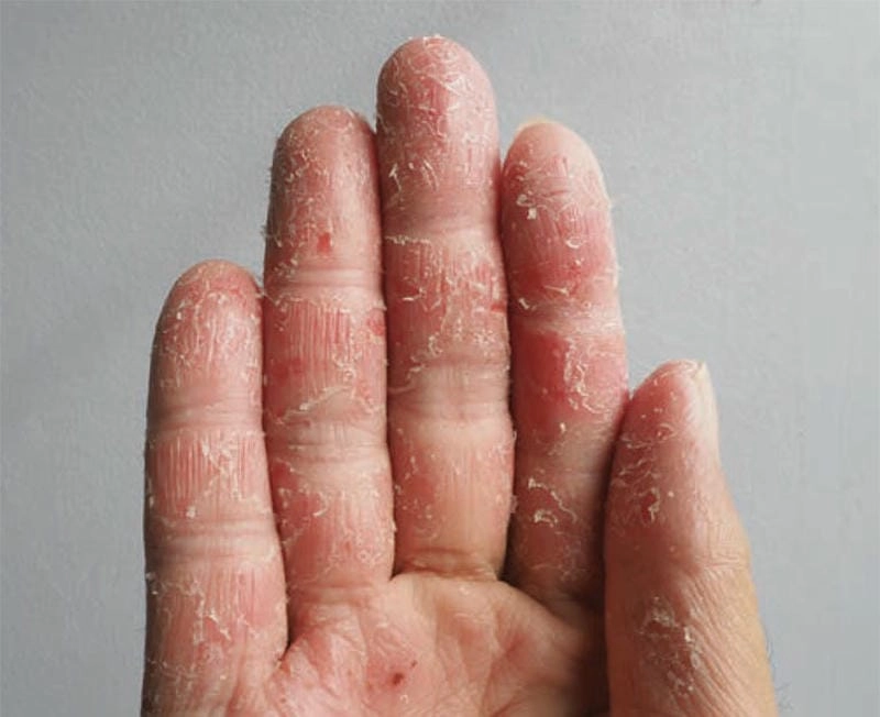 Hình ảnh viêm da cơ địa ở tay cho thấy mảng đỏ khô rát và ngứa