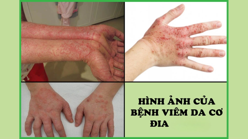 Hình ảnh bệnh viêm da cơ địa là như thế nào