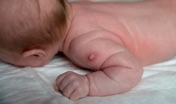 Cập nhật hình ảnh viêm da tiếp xúc dị ứng thường thấy trên da