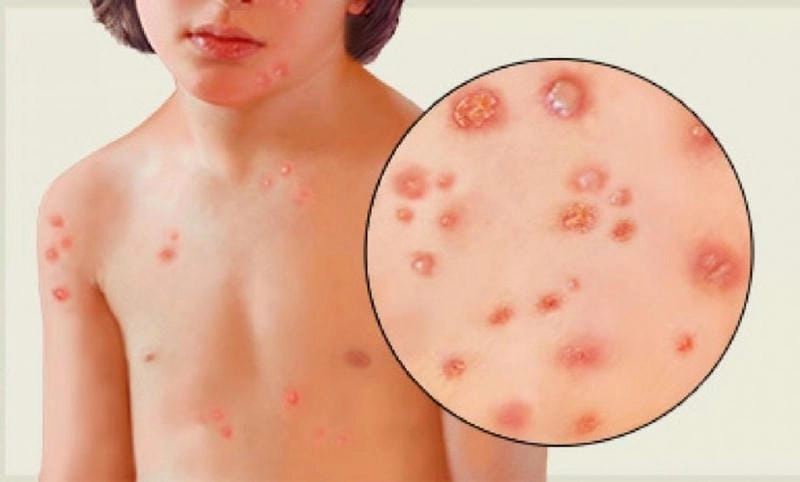 Hình ảnh viêm da ở trẻ em dễ gặp khi thời tiết thay đổi