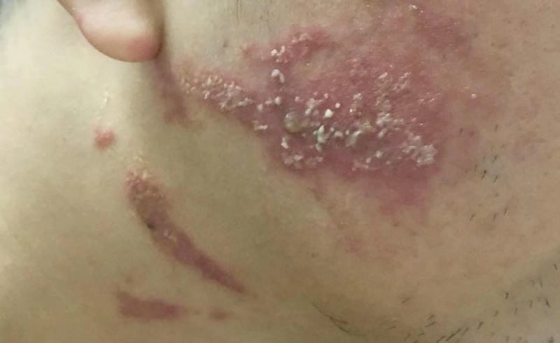 Hình ảnh viêm da cơ địa người lớn thường xuất hiện ở chân tay