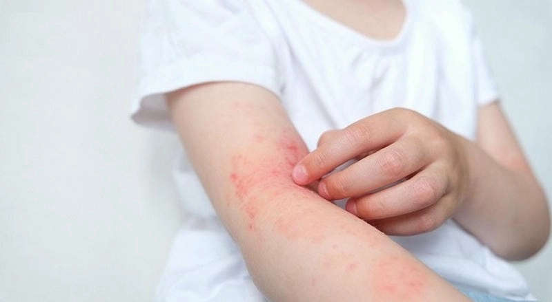 Hình ảnh viêm da giúp nhận biết sớm triệu chứng da liễu