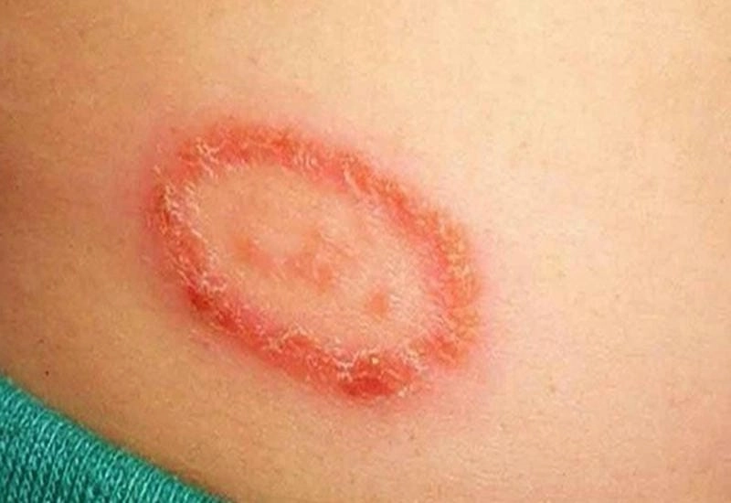Tham khảo hình ảnh viêm da dị ứng ở mặt để phòng ngừa kịp thời