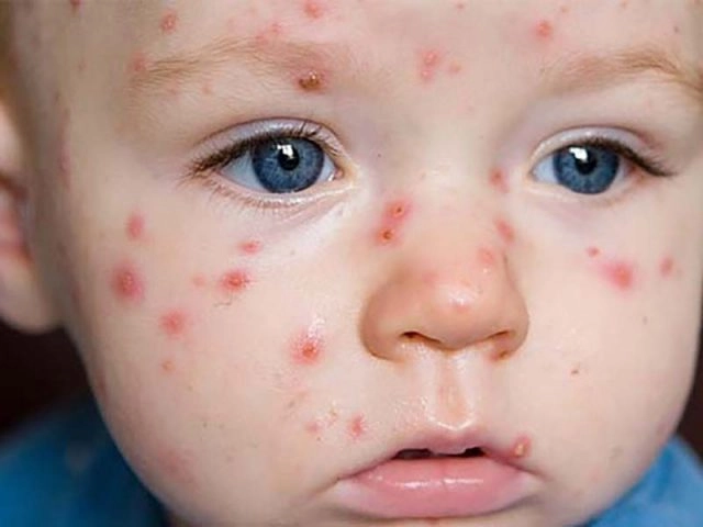 Tổng hợp hình ảnh viêm da mặt với nhiều biểu hiện khác nhau