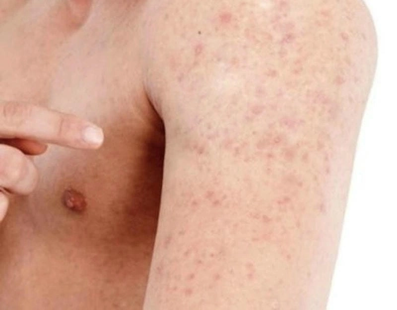 Phân biệt hình ảnh viêm da dầu và các loại viêm da khác