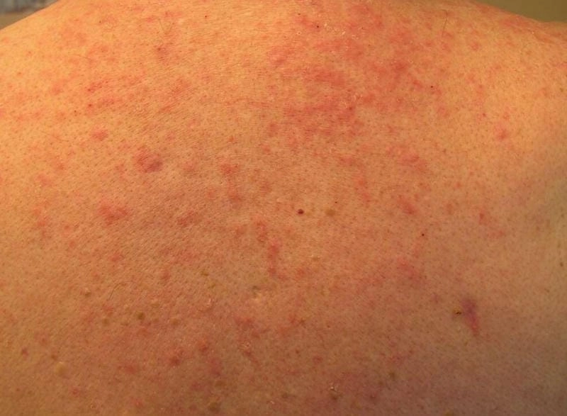 Dễ nhận biết hình ảnh viêm da dị ứng thời tiết vào giao mùa