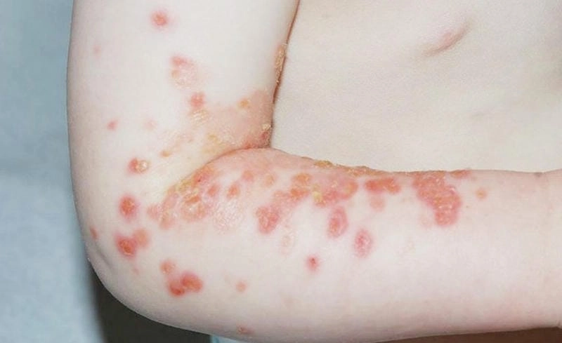 Ảnh viêm da giúp nhận biết triệu chứng phổ biến sớm