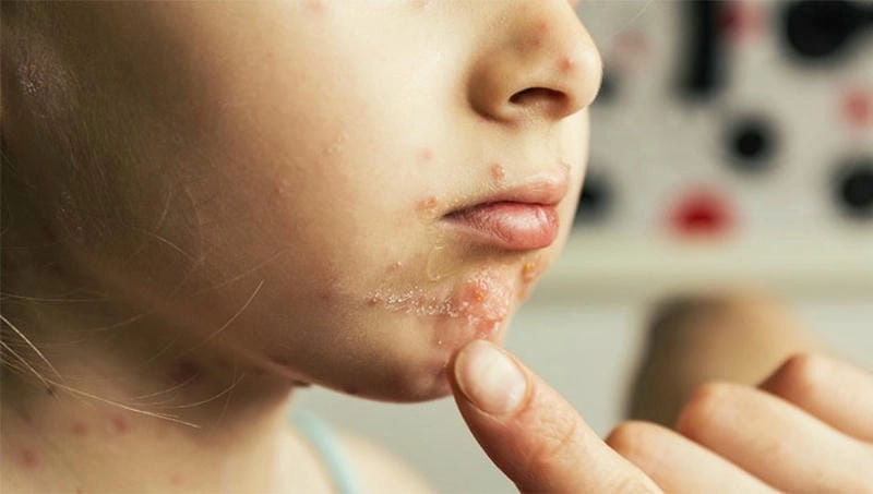 Hình ảnh các loại viêm da giúp phân biệt triệu chứng rõ ràng