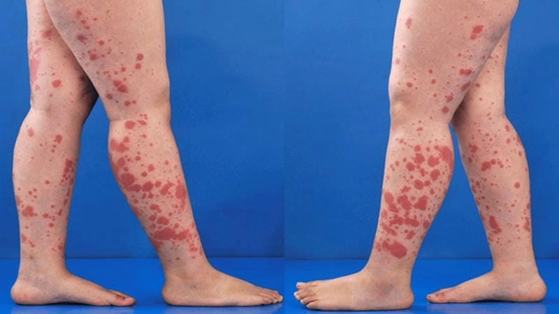 Khám phá viêm mao mạch dị ứng qua hình ảnh rõ ràng dễ hiểu