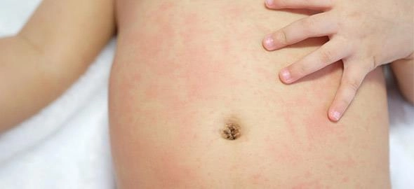 Minh họa viêm mao mạch dị ứng bệnh học dễ hiểu