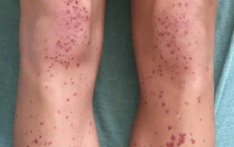 Xem ảnh mô tả viêm mao mạch dị ứng bệnh học trong tài liệu y khoa chi tiết