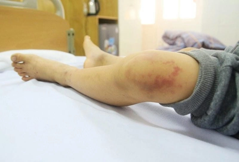 Tổng hợp nhiều ảnh viêm mao mạch dị ứng chất lượng cao dễ quan sát