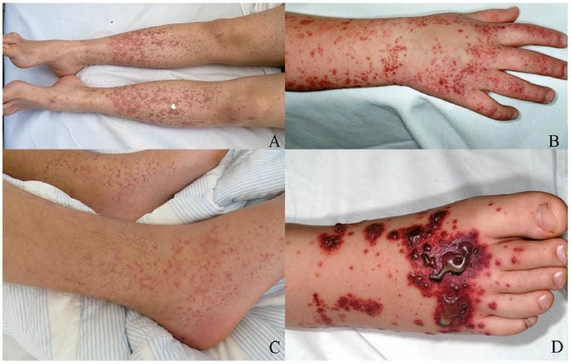 Xem ngay ảnh bị bệnh viêm mao mạch dị ứng rõ nét cho người quan tâm