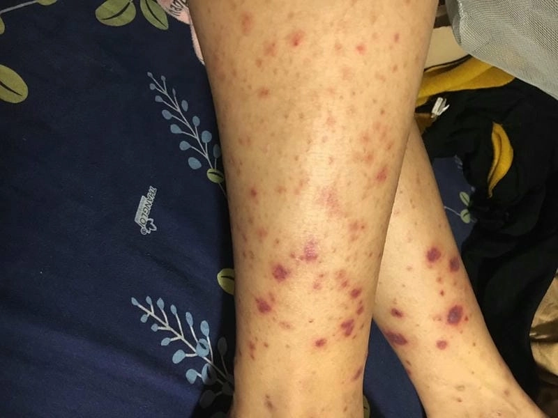 Theo dõi hình ảnh người bị bệnh viêm mao mạch dị ứng chân thực nhất