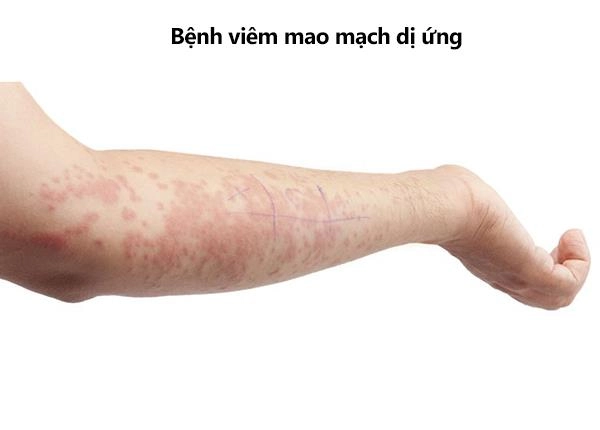 Bộ sưu tập ảnh viêm mao mạch dị ứng rõ nét dễ hiểu