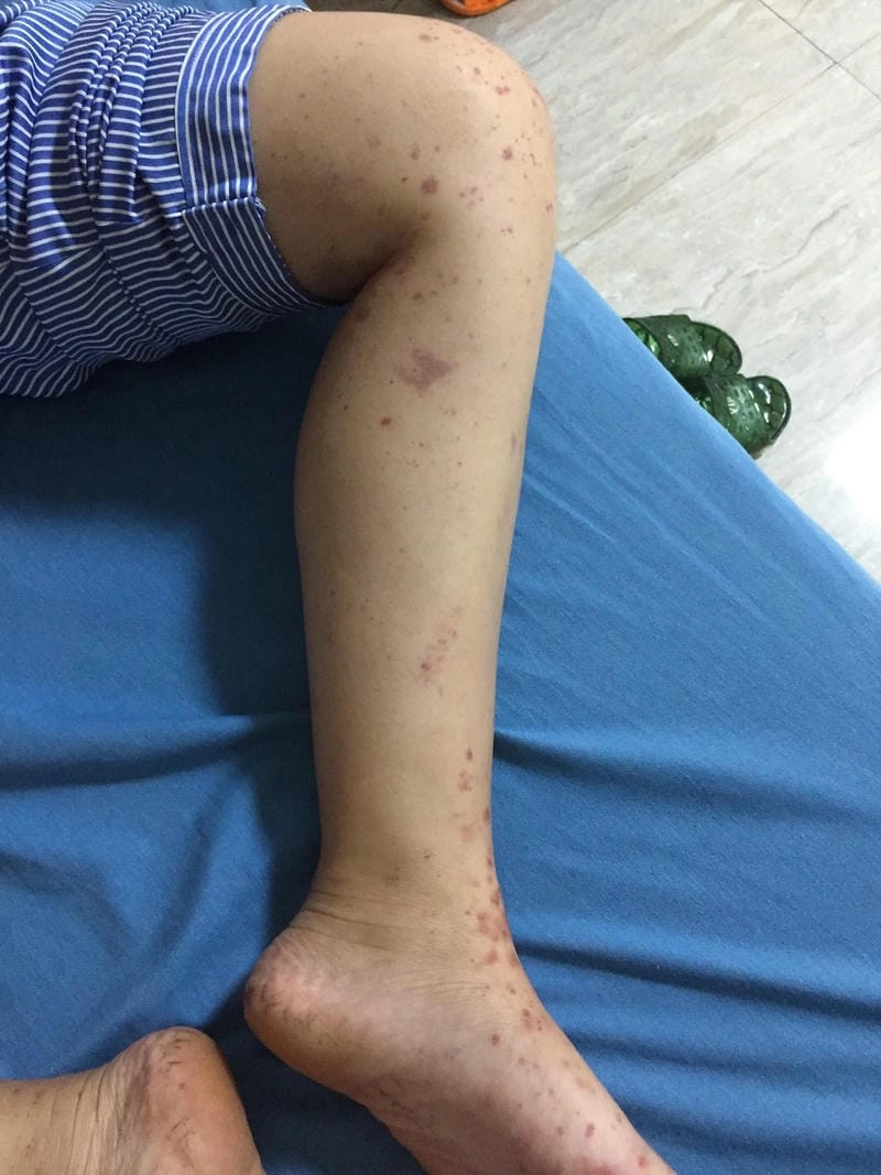 Bộ sưu tập hình ảnh bị viêm mao mạch dị ứng đầy đủ dấu hiệu bệnh lý