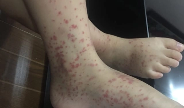 Hình thực tế viem mao mach di ung ở bệnh nhân