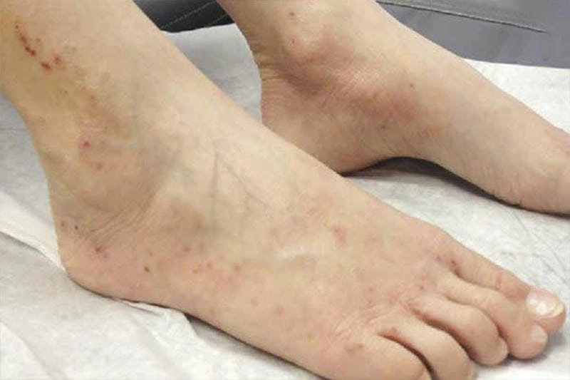 Cập nhật ảnh người bị bệnh viêm mao mạch dị ứng thực tế từ bệnh viện