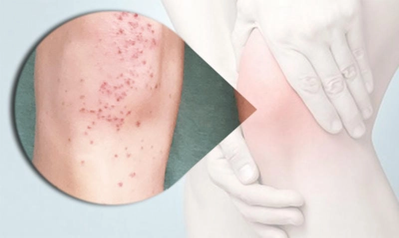 Hình dấu hiệu viêm mao mạch ở da thực tế