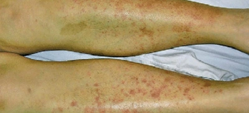 Triệu chứng dị ứng mao mạch qua hình ảnh