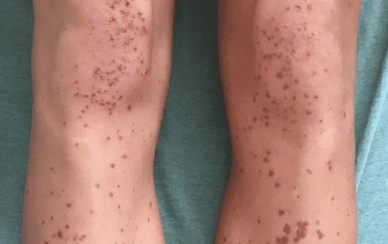 Theo dõi biểu hiện mao mạch dị ứng rõ nét