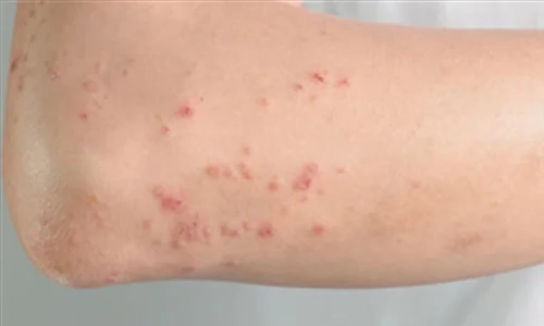 Ảnh giải đáp viêm mao mạch dị ứng có tự khỏi không