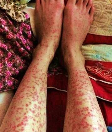 Ảnh triệu chứng viêm mao mạch dị ứng ở người lớn