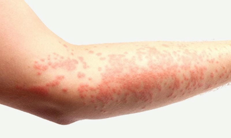 Nhận biết viêm mao mạch ở da với dấu hiệu lâm sàng thường gặp