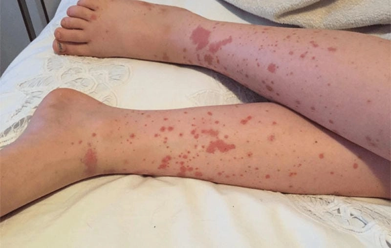 Tìm hiểu benh viem mao mach di ung qua ảnh minh họa trực quan chi tiết