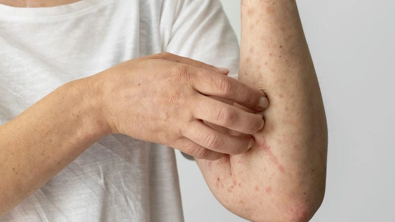 Xem ngay cách trị viêm mao mạch dị ứng bằng phương pháp hiệu quả hiện nay