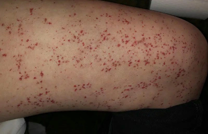 Hình ảnh mô tả rõ triệu chứng dị ứng mao mạch trên bề mặt da người