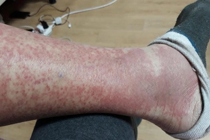 Theo dõi biểu hiện mao mạch dị ứng thông qua ảnh thực tế bệnh nhân