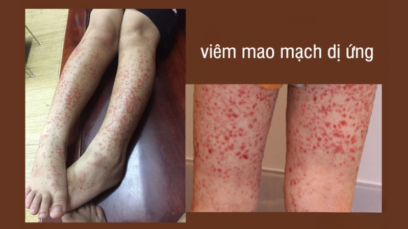 Viêm mao mạch dị ứng là như thế nào