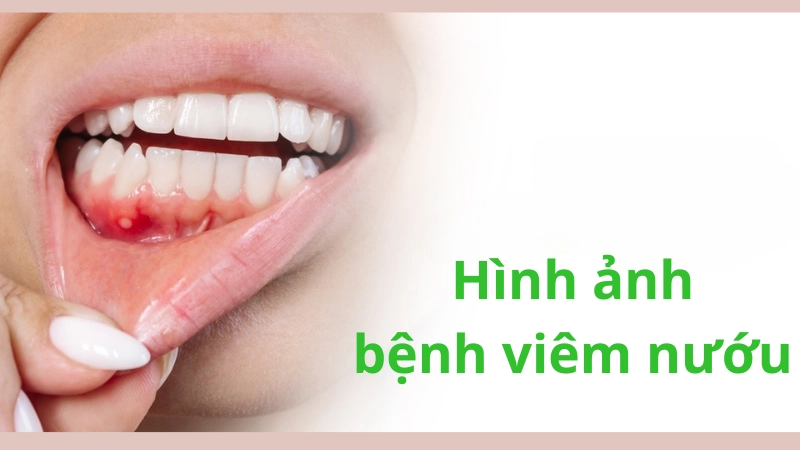 Viêm nướu là như thế nào mà khiến hoảng hốt