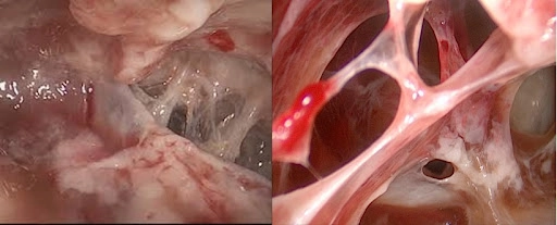 Tìm hiểu chi tiết về bệnh viêm phổi người lớn phổ biến