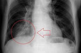 Cập nhật cảnh báo hình ảnh trẻ sơ sinh viêm phổi nặng