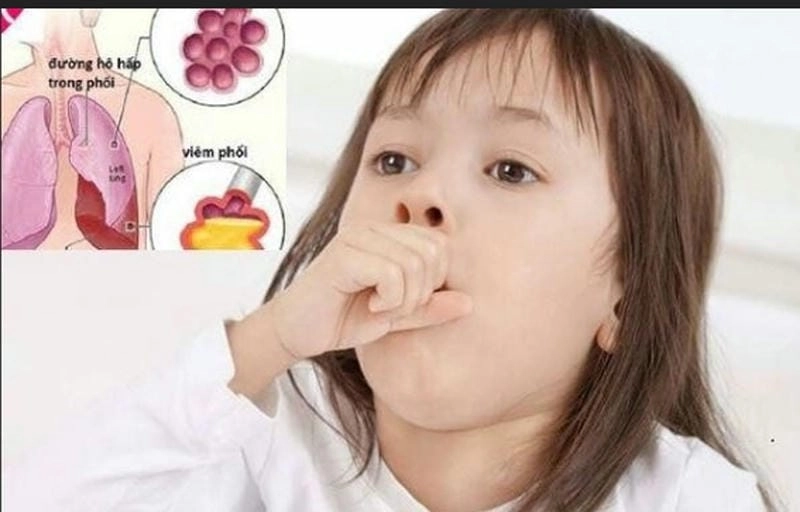 Theo dõi biểu hiện sớm của trẻ bị viêm phổi