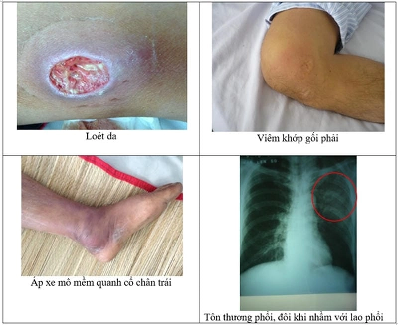 Khám phá hình ảnh bệnh whitmore chi tiết rõ nét