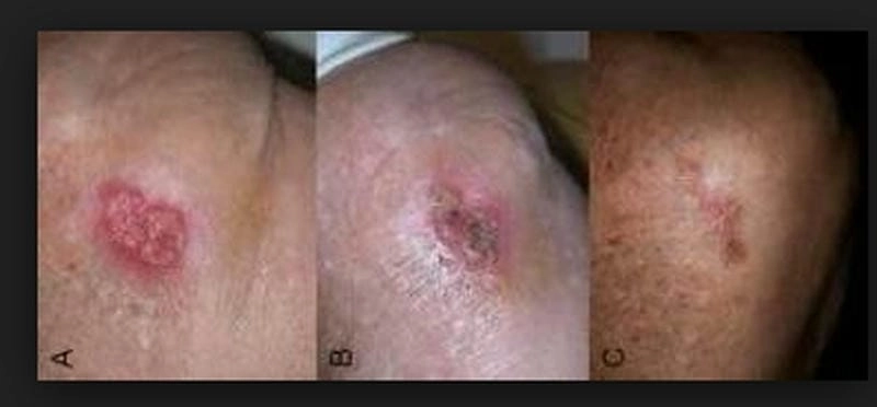 Cập nhật hình ảnh người bị bệnh whitmore mới nhất