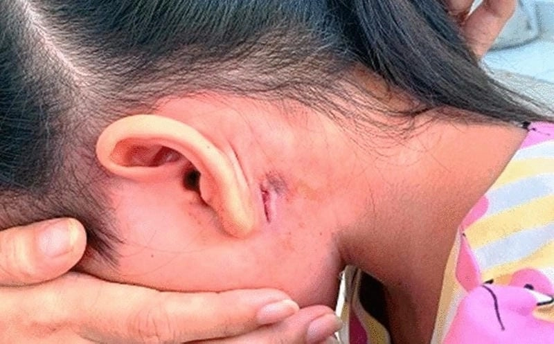 Tìm hiểu ảnh người bệnh whitmore rõ nét từng chi tiết