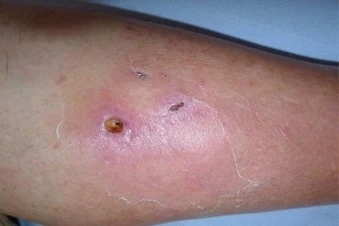 Cập nhật y khoa với ảnh bệnh whitmore mới nhất