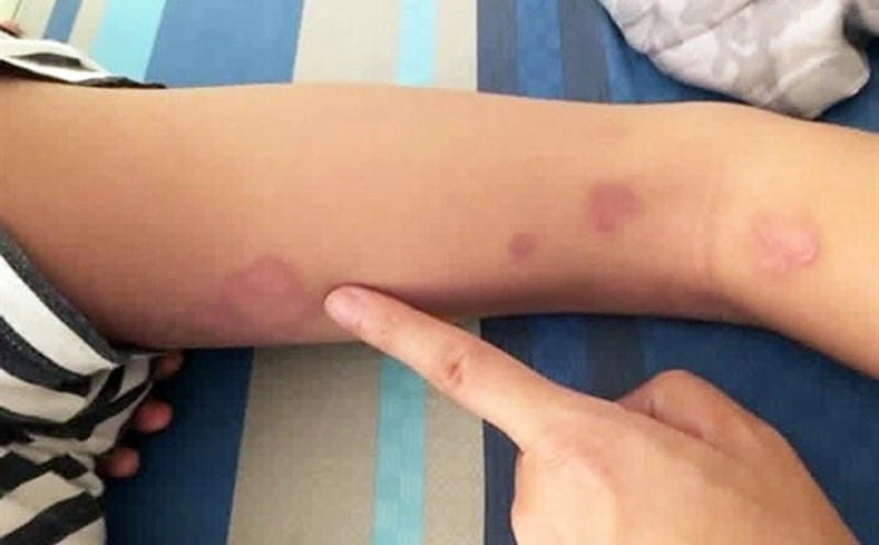 Giải thích triệu chứng nhiễm khuẩn whitmore dễ nhận biết