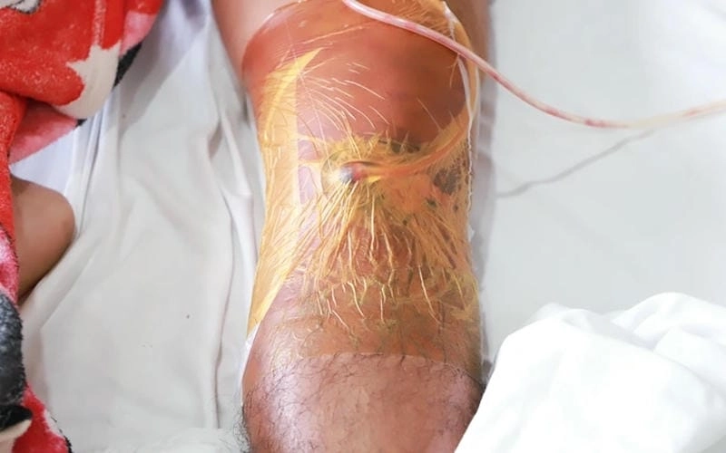 Hiểu rõ nguyên nhân và triệu chứng benh whitmore