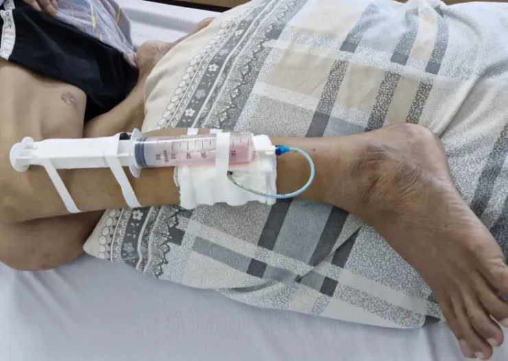 Hình ảnh thực tế qua ảnh bệnh whitmore rõ nét