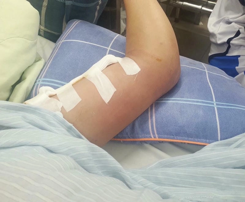 Giải thích dễ hiểu benh whitmore la gi cho người đọc